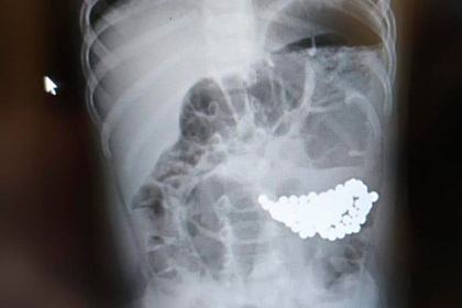 Московские хирурги достали из желудка мальчика 117 магнитных шаров